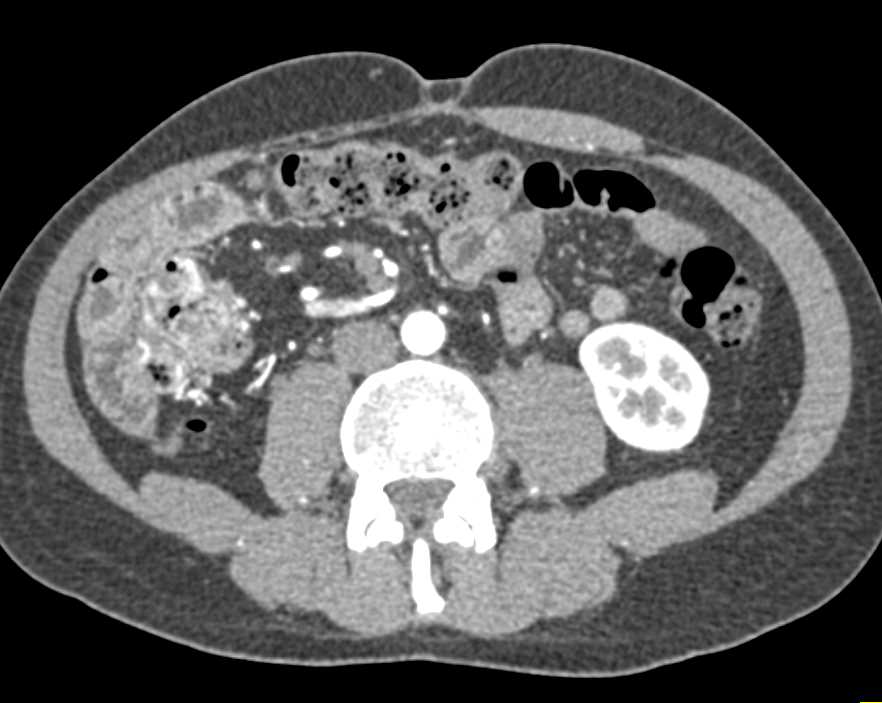 Resection Right Lobe Liver for Hepatocellular Carcinoma (Hepatoma) - CTisus CT Scan