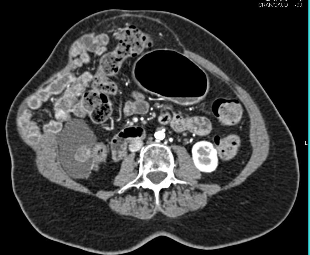 Metastatic Carcinoid Tumor with Vascular Metastases - CTisus CT Scan