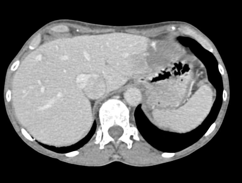 Hemangioma Left Lobe of the Liver - CTisus CT Scan