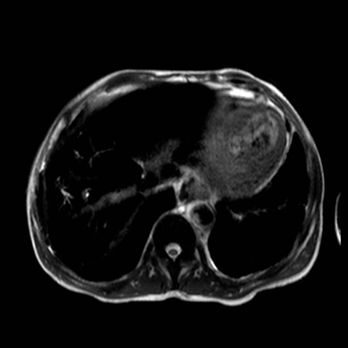 Hemosiderosis in the Liver in a patient with sickle cell anemia. - CTisus CT Scan