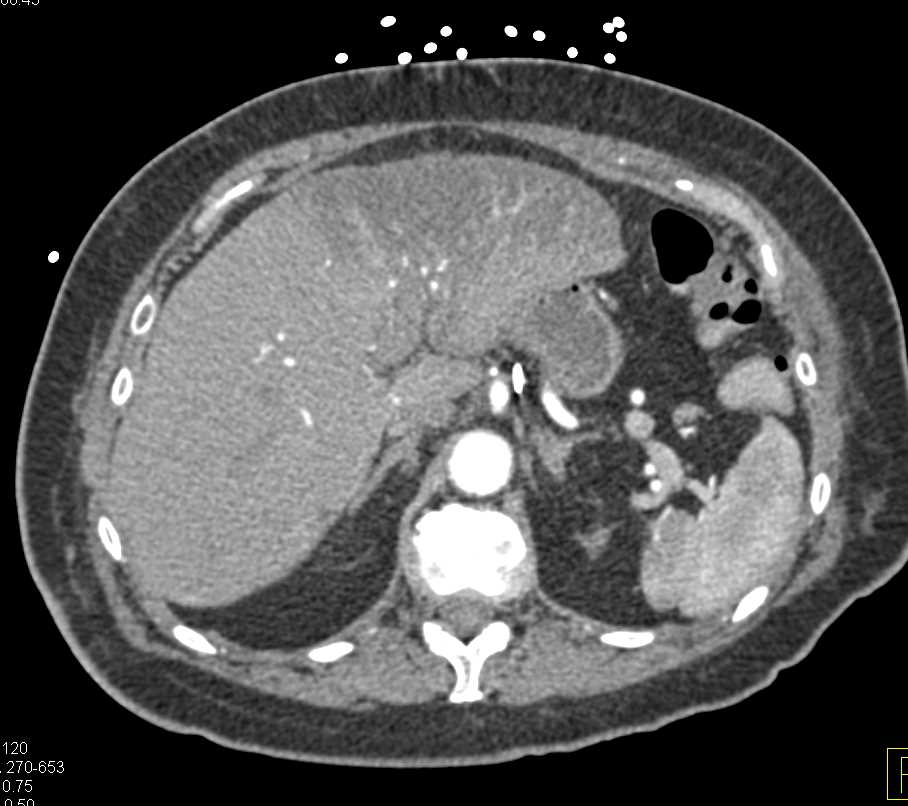 Fatty Liver Following Injury to Left Lobe due to Retraction During Surgery - CTisus CT Scan