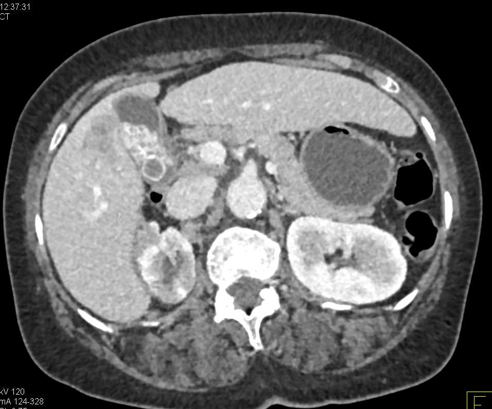 Invasive Gallbladder Cancer with Gallstones - CTisus CT Scan