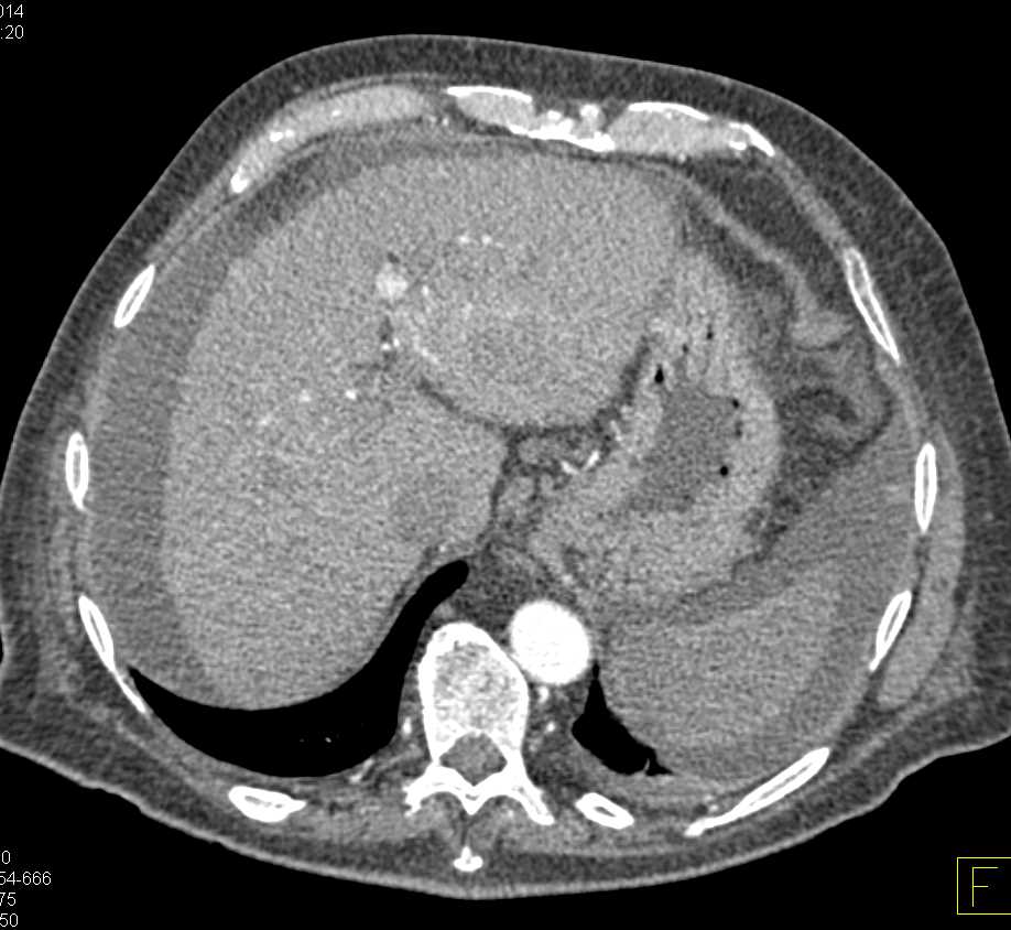 Cirrhosis with Portal Vein Thrombosis and Portal Hypertension - CTisus CT Scan