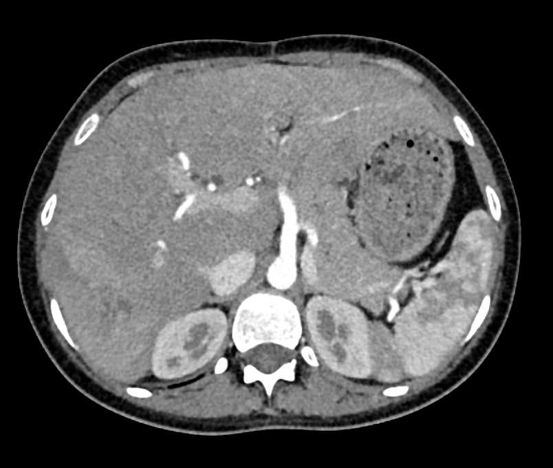 Liver Metastases from a Carcinoid Tumor - CTisus CT Scan