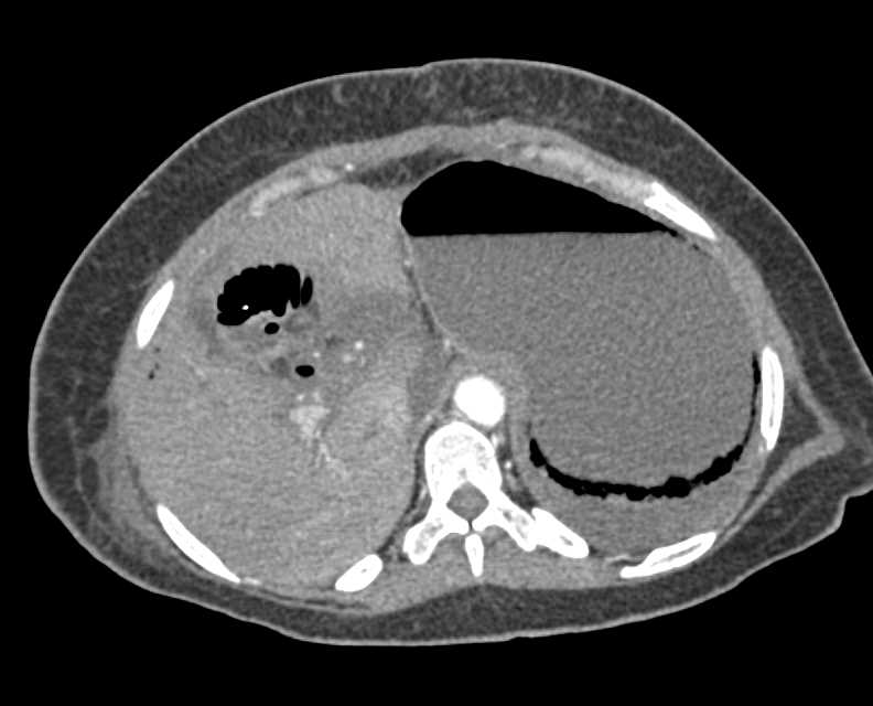 Liver Infarction and Gastric Emphysema - CTisus CT Scan
