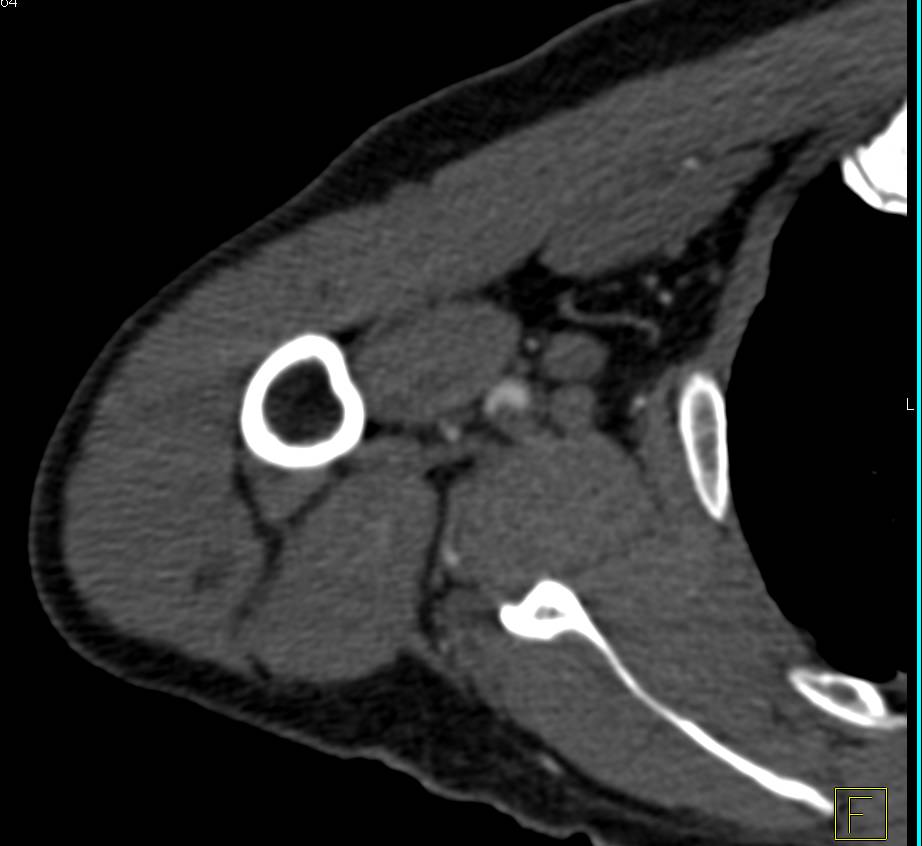 Trauma with Occluded Brachial Artery - CTisus CT Scan