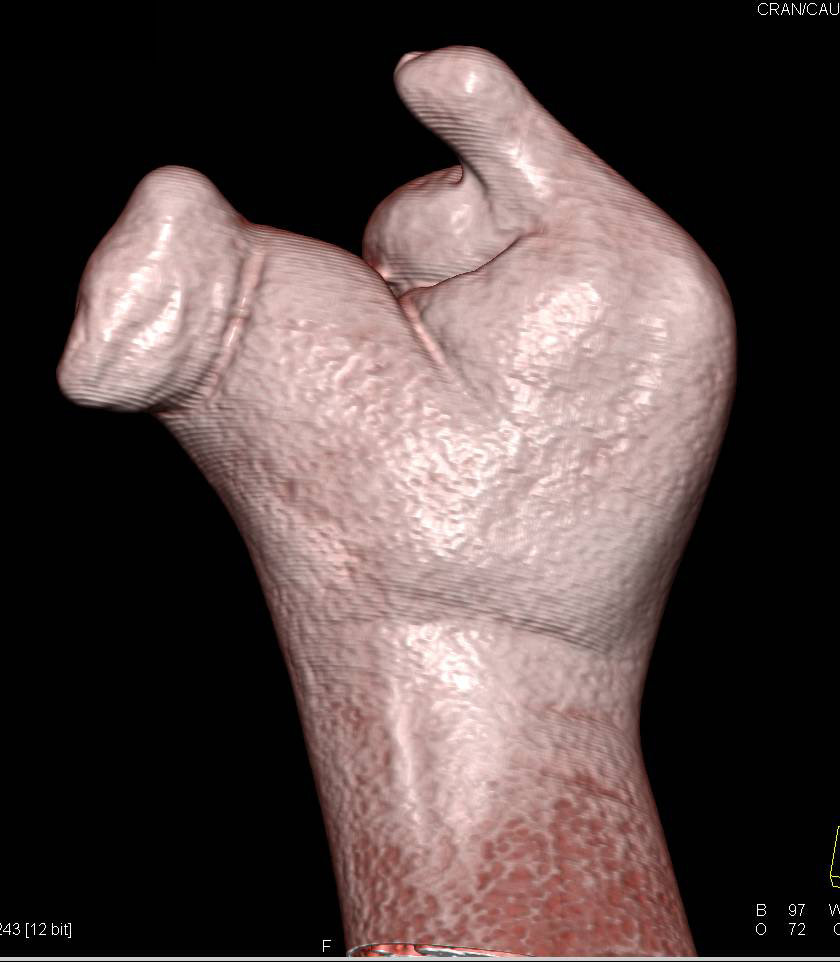 Congenital Deformity of the Hand - CTisus CT Scan