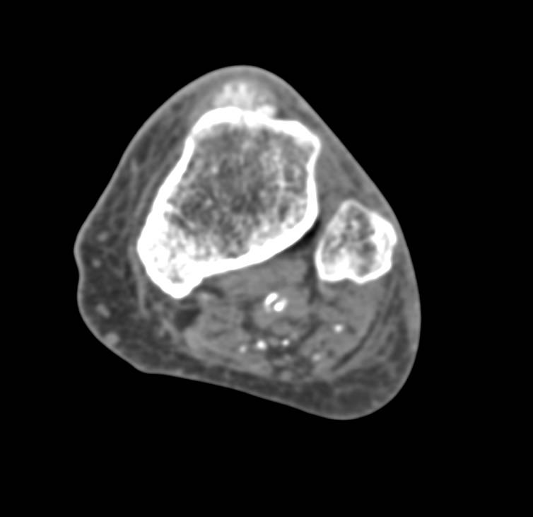 Classic Case of Gout Involving the Ankle Joint and Foot Analyzed with Dual Energy CT - CTisus CT Scan
