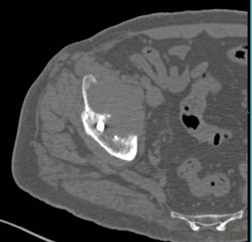 Multiple Myeloma - CTisus CT Scan