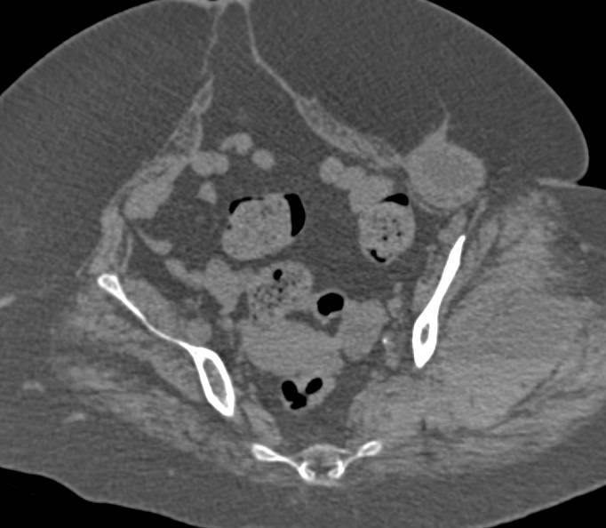 Hematoma Left Thigh Intramuscular Bleed - CTisus CT Scan