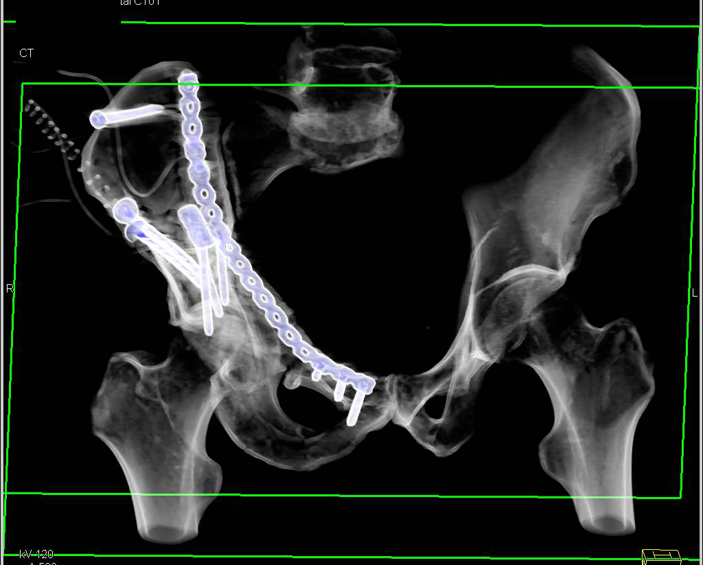 Surgical Repair of Complex Pelvic Fractures with Hardware in Place - CTisus CT Scan