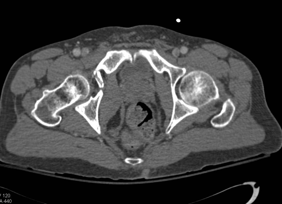 Complex Right Acetabular Fracture - CTisus CT Scan