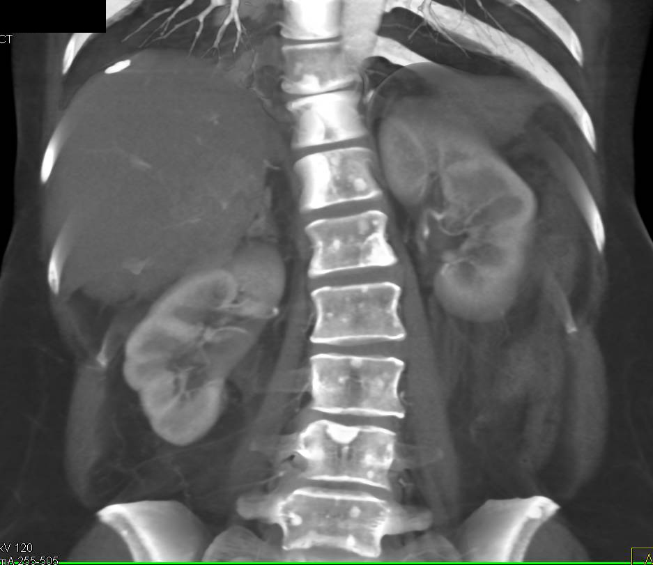 Sclerotic Bone Metastases from Carcinoid Tumor - CTisus CT Scan