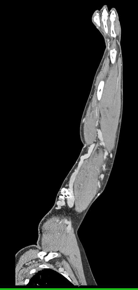 Arteriovenous (AV) Shunt in Dialysis Patient - CTisus CT Scan