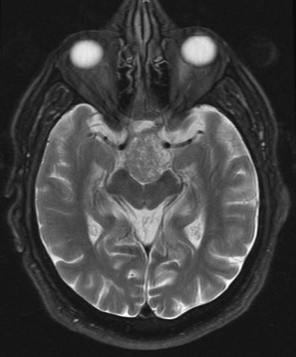 Pituitary Macroadenoma. - CTisus CT Scan