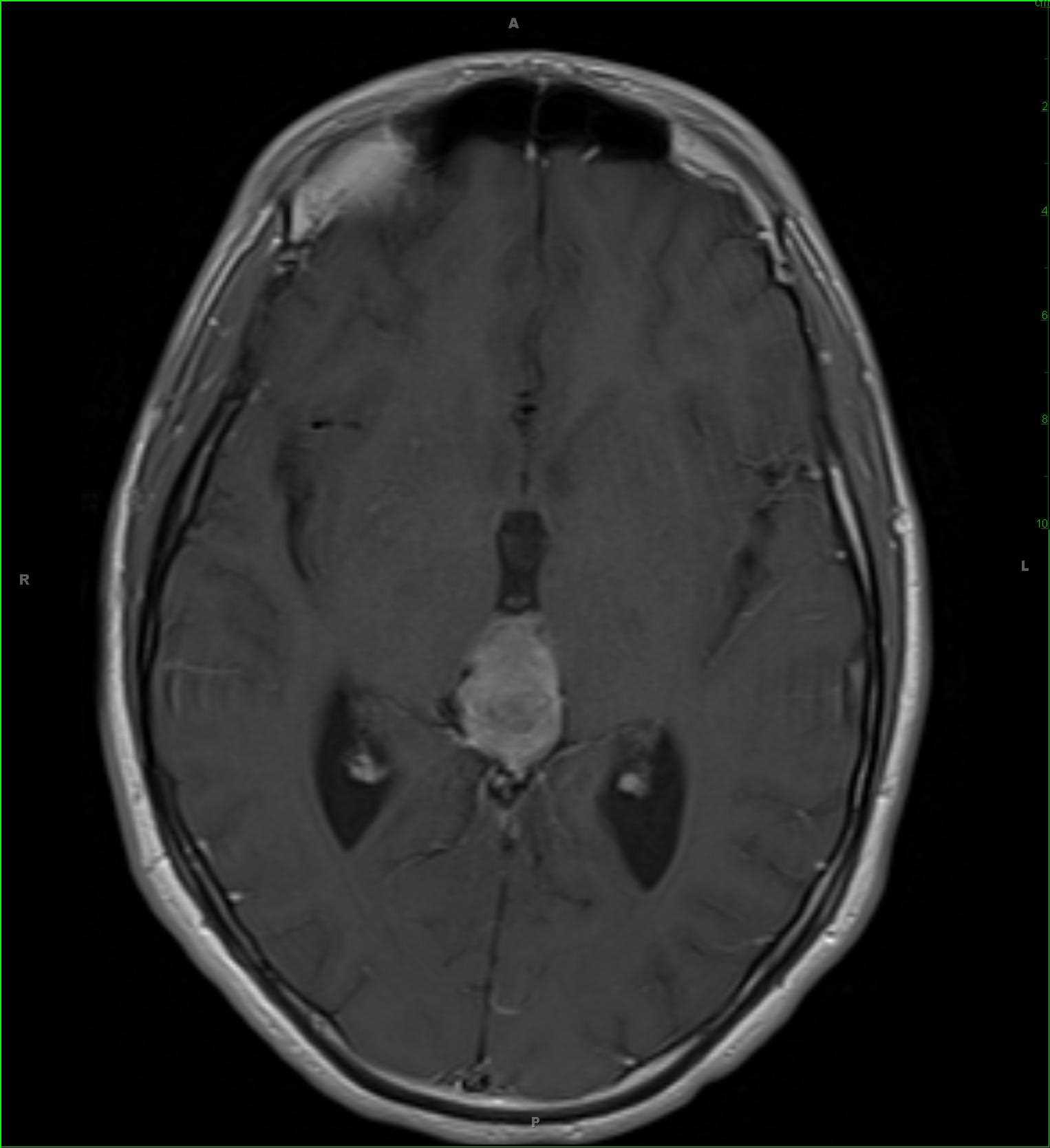 Pineal Tumor, Nongerminomatous Germ Cell Tumor - CTisus CT Scan