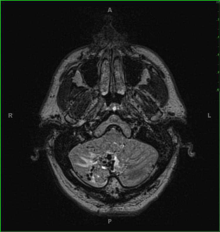 Hemangioblastoma - CTisus CT Scan