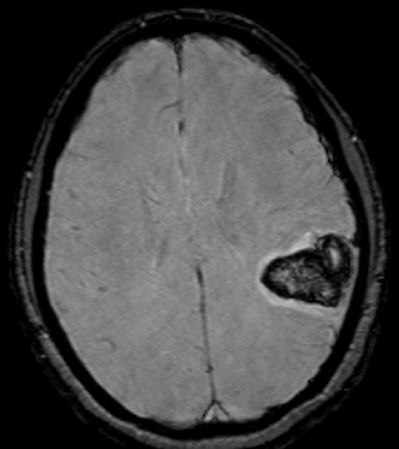 Hemorrhagic Arteriovenous Malformation - CTisus CT Scan