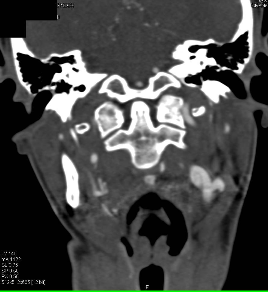 Focal Dissection Left Carotid Artery - CTisus CT Scan