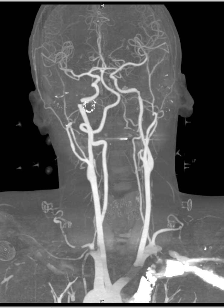 Normal Carotid Circulation with Classic Dual Energy Artifacts due to High Density Contrast - CTisus CT Scan