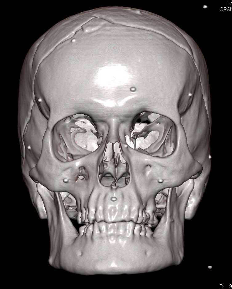 3D Modeling to Simulate Cranial-facial Surgery - CTisus CT Scan