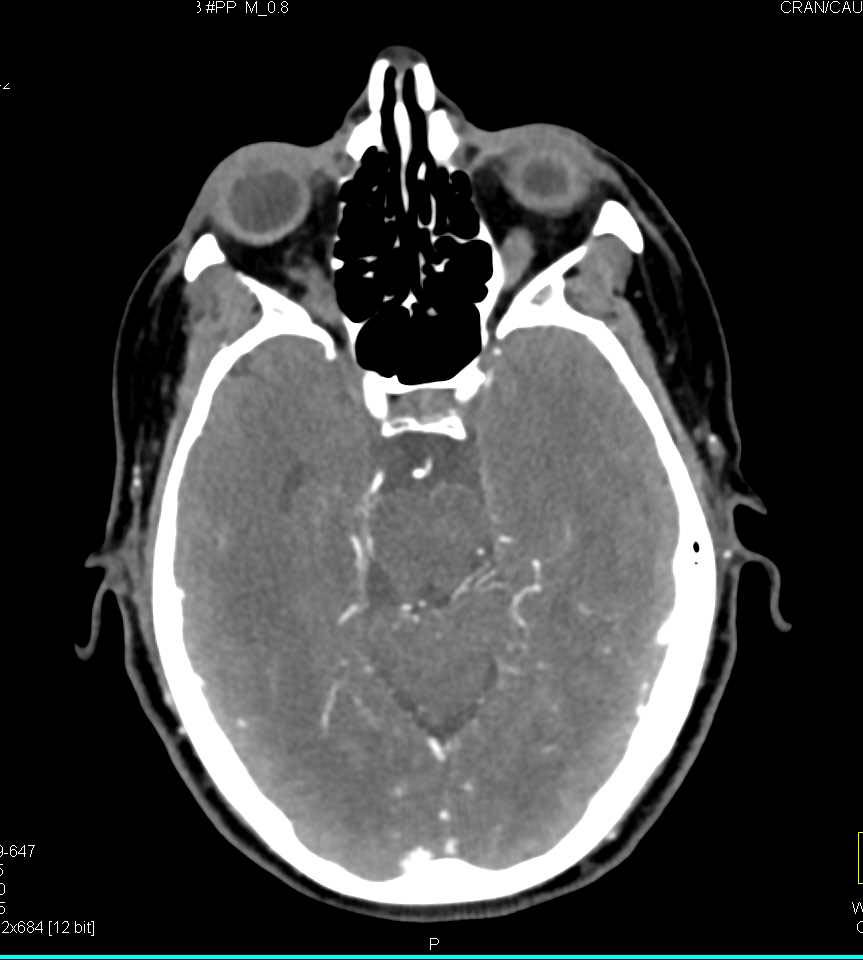 Carotid Artery Disease - CTisus CT Scan