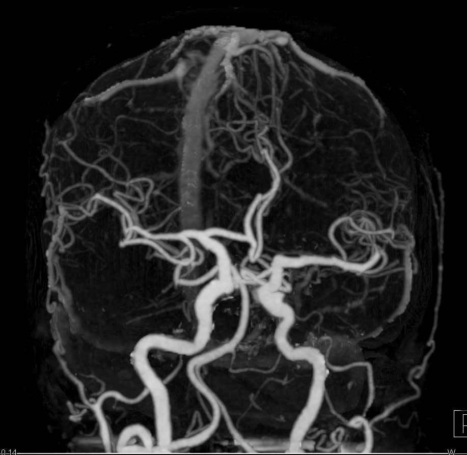 CTA of Intracranial Circulation - CTisus CT Scan
