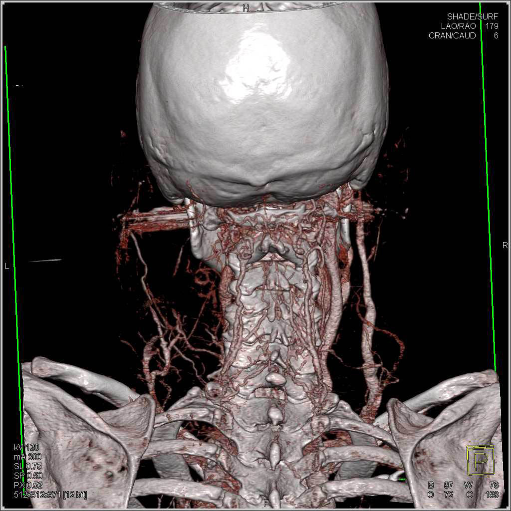 Lymphoma with Massive Neck Adenopathy - CTisus CT Scan