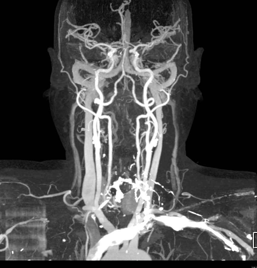 CTA of the Neck with Dual Energy Bone Removal - CTisus CT Scan