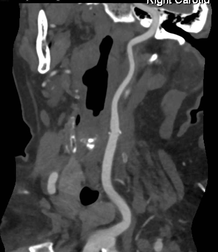 CTA Carotid Arteries with Minimal Plaque - CTisus CT Scan