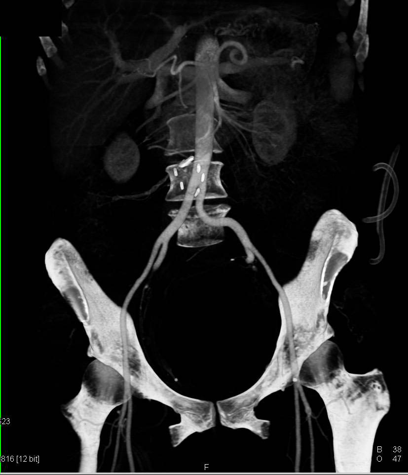 Ovarian Carcinoma - CTisus CT Scan
