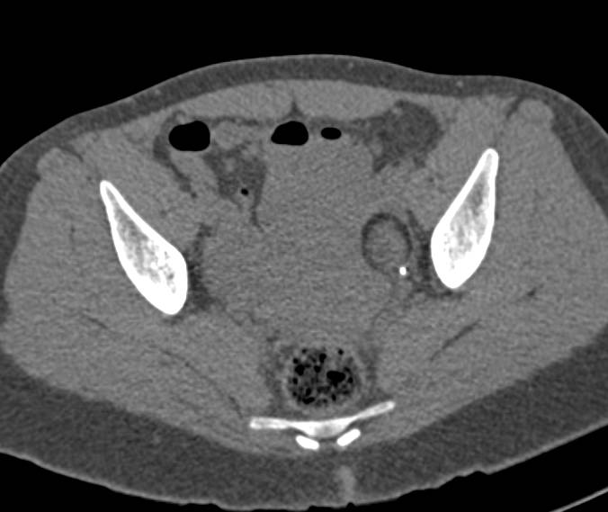 Dermoid of the Ovary - CTisus CT Scan