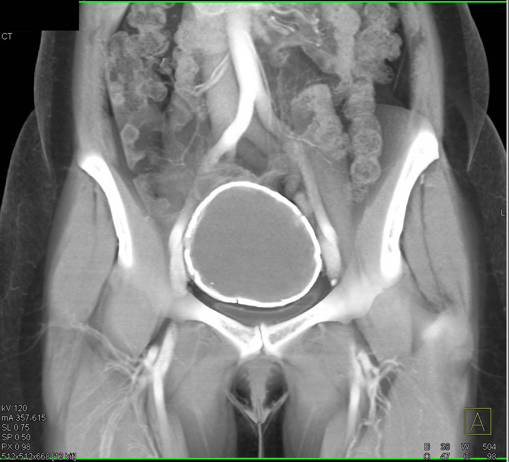 Calcified Fibroid - CTisus CT Scan