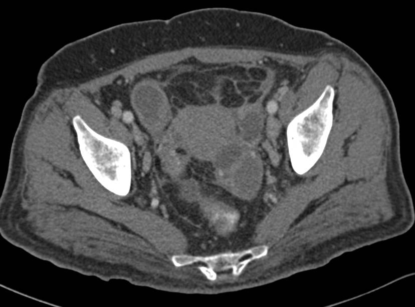 PID (Pelvic Inflammatory Disease) - CTisus CT Scan