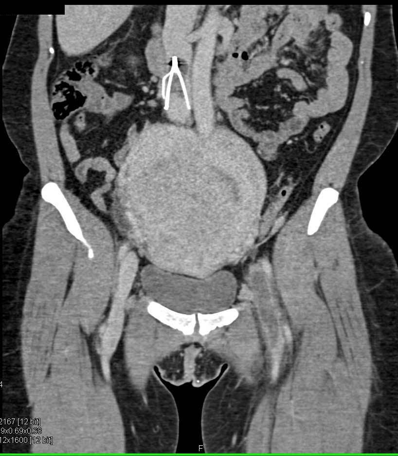 Invasive Uterine Cancer with Inferior Vena Cava (IVC) Clot and Filter - CTisus CT Scan