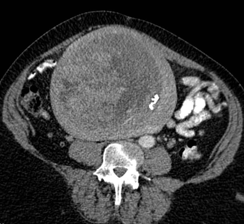 Degenerating Uterine Fibroid - CTisus CT Scan