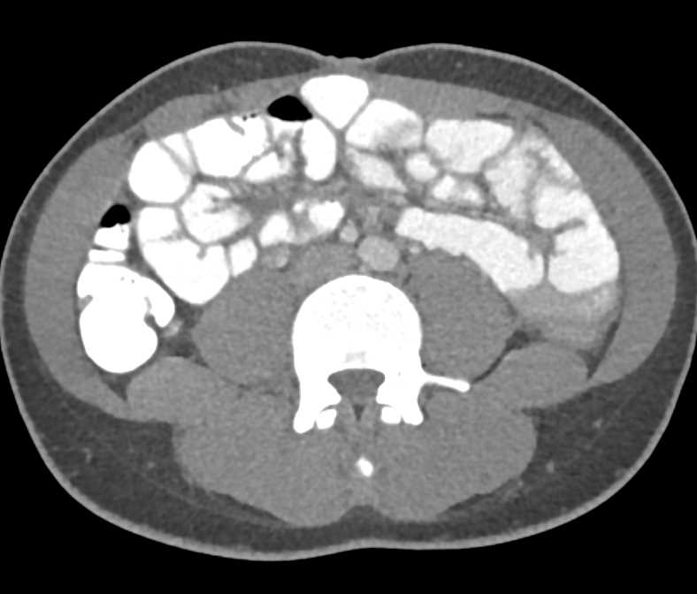 Unsuspected Intrauterine Pregnancy - CTisus CT Scan