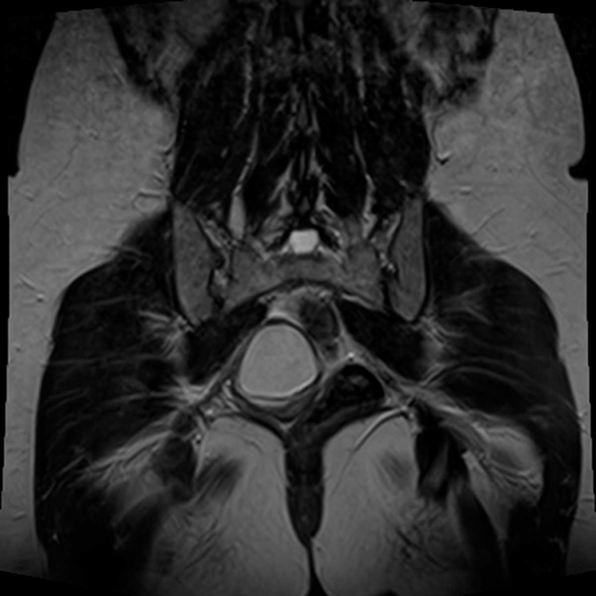 Ovarian Dermoid - CTisus CT Scan
