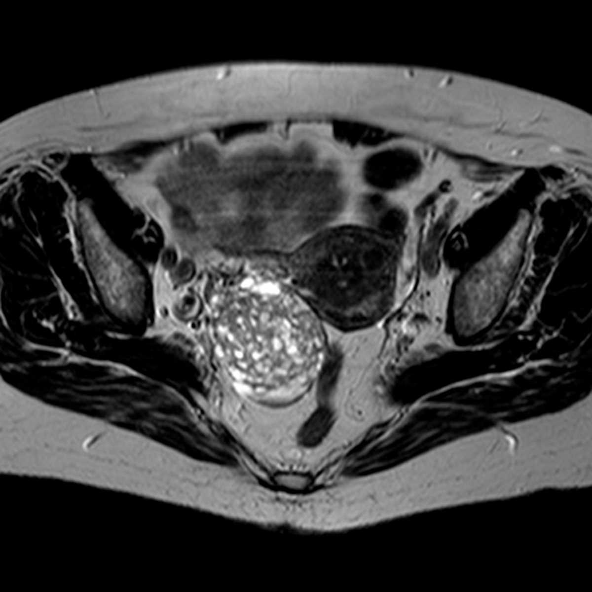 Ovarian Granulosa Cell Tumor - CTisus CT Scan