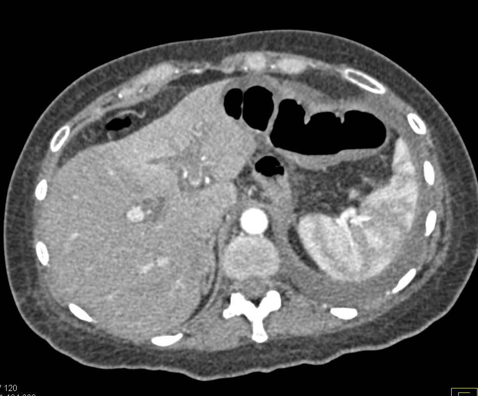 Small Bowel Obstruction with Carcinomatosis due to Ovarian Cancer - CTisus CT Scan