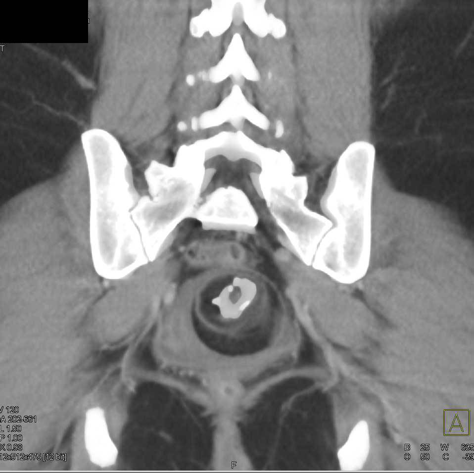 Dermoid Ovary and Blastic Bone Metastases - CTisus CT Scan