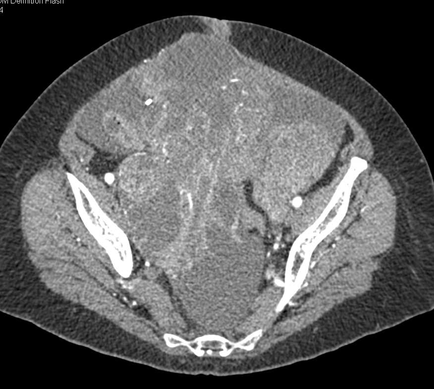 Uterine Sarcoma with Neovascularity - CTisus CT Scan
