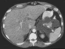 acute pancreatitis case study acute pancreatitis case study