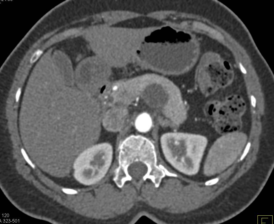 Serous Cystadenoma of the Pancreas - CTisus CT Scan