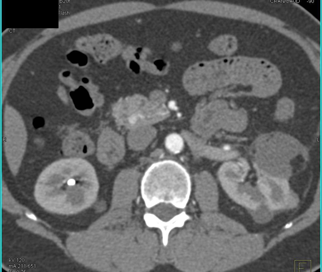 6 mm Neuroendocrine Tumor in the Head of the Pancreas - CTisus CT Scan