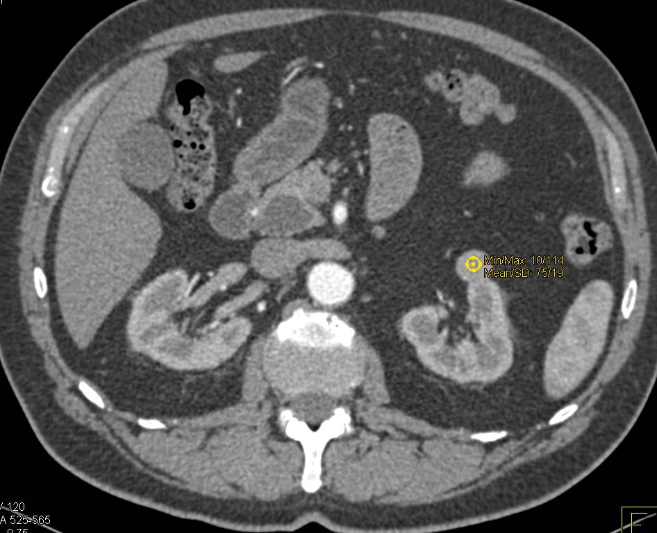 Intraductal Papillary Mucinous Neoplasm (IPMN) in Head of Pancreas and Incidental Left Renal Cell Carcinoma - CTisus CT Scan