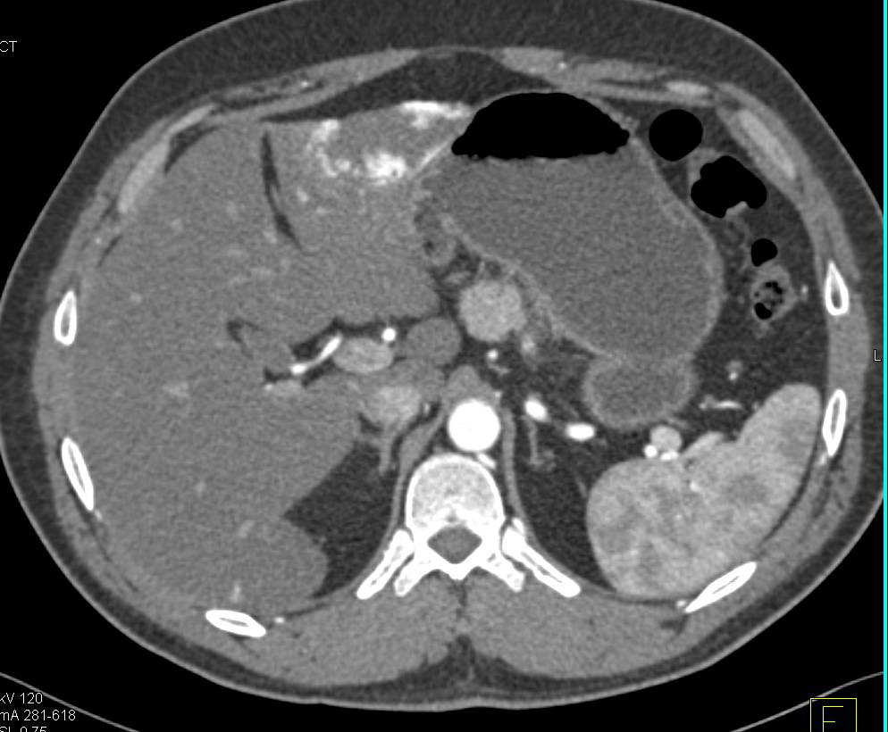 Mucinous Neoplasm of the Pancreas (MCN) with Multiple Hepatic Hemangiomas - CTisus CT Scan