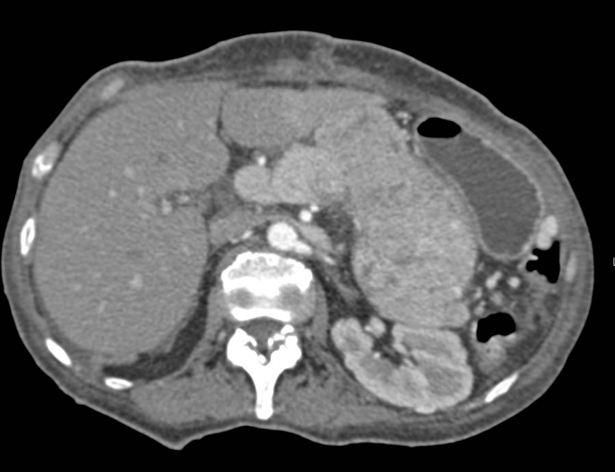 Renal Cell Carcinoma Metastatic to the Pancreas with Entire Gland Involved and Splenic Vein Occlusion - CTisus CT Scan