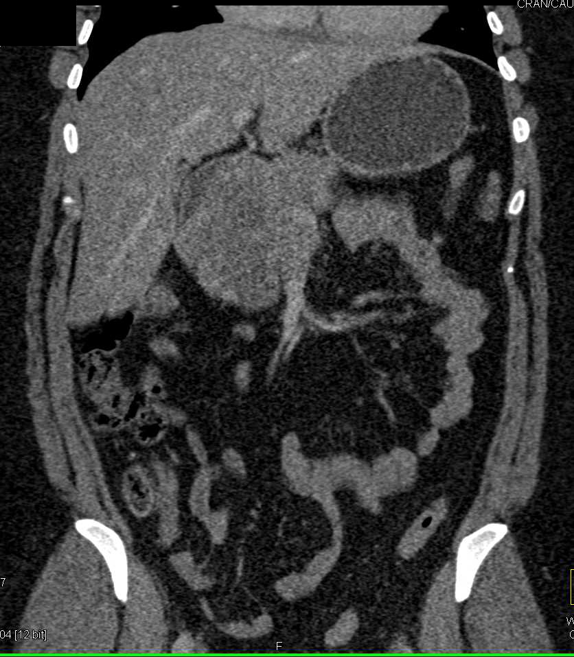 SPEN (Solid and Papillary Epithelial Neoplasm) - CTisus CT Scan