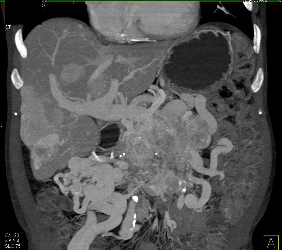 Neuroendocrine Tumor of the Pancreas with Liver Metastases - CTisus CT Scan